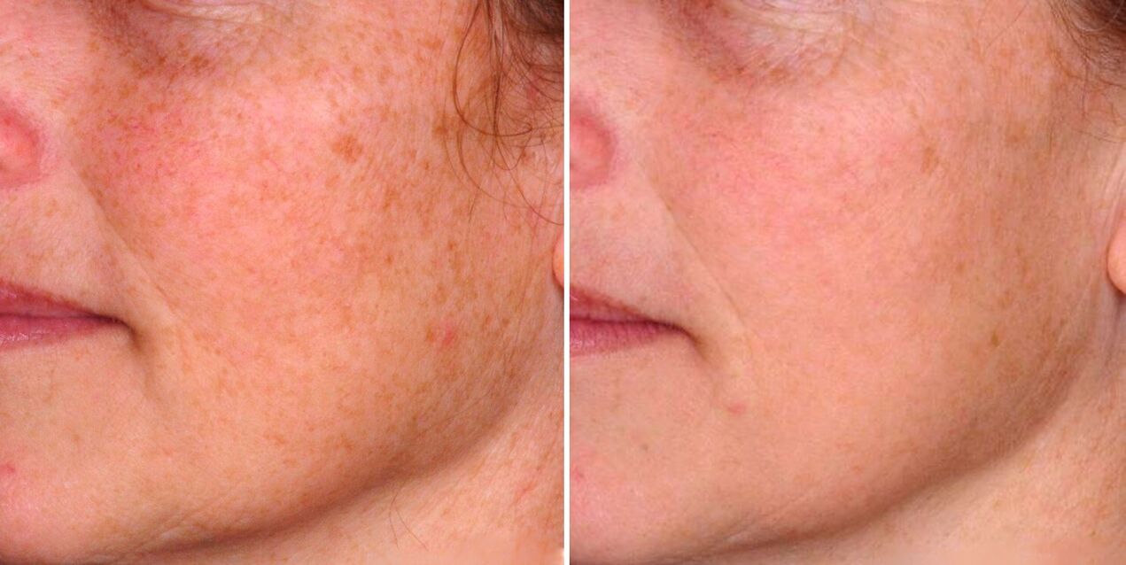 部分光热作用的结果是减少面部皮肤上的老年斑。
